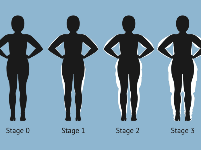 Any stage of lipedema can improve on keto